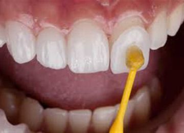 بـ خل التفاح وقشر البرتقال .. 4 طرق منزلية لتنظيف الجير المتراكم على الأسنان