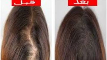 7 حيل خارقة .. علاج الفروة الدهنية وتساقط الشعر