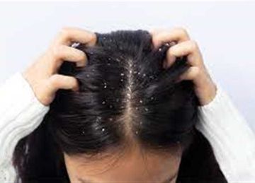 استخدمي خل التفاح وابتعدي عن المثبتات.. 5 حلول فعالة للتخلص من قشرة الشعر