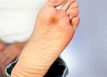 قرح القدم السكري الأسباب وطرق الوقاية.. احترس مضاعفات المرض تصل لـ الغرغرينا والبتر 