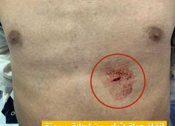 طعنة اخترقت البطين الأيسر للقلب.. إنقاذ حياة شاب بمستشفى المنصورة الدولي