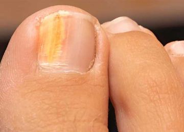 عدوى فطرية.. أخطاء تحول أظافر القدمين إلى اللون الأصفر في الطقس الحار