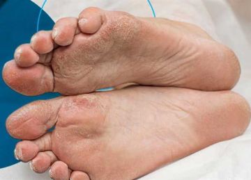  إهمالها ينتهي ببتر القدم .. أعراض القدم السكري وطرق الوقاية