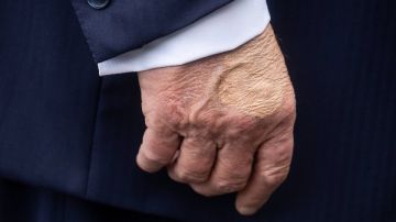 احتباس للسوائل تطورات الحالة الصحية للرئيس الأمريكي ترامب بعد الفحوصات وكدمات اليد