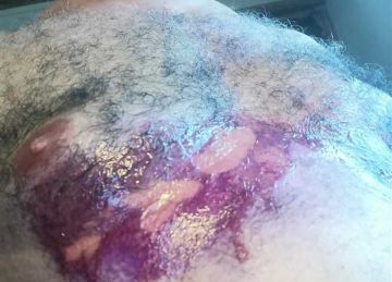 محام يتهم طبيب جلدية شهير بكفر الزيات: كتب لي تركيبة حارقة