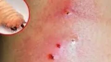 أول حالة إصابة بشرية بالدودة الحلزونية الآكلة للحوم في أمريكا.. ما هي؟