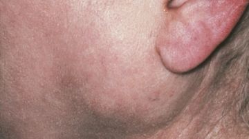 تدمر المخ.. اعرف أعراض التهاب الغدد اللعابية وأسبابها والأكثر عرضة لها