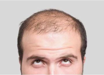 للرجال.. 7 أطعمة تساعد على الوقاية من الصلع المبكر