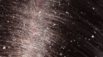 3 طرق طبيعية وفعالة للتخلص من قشرة الشعر الدهنية