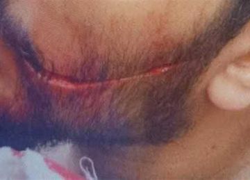 أحدث عاهة مستديمة .. اعتداء بمشرط جراحي على طبيب بمستشفى سيد جلال الجامعي  أحدث عاهة مستديمة .. اعتداء بمشرط جراحي على طبيب بمستشفى سيد جلال الجامعي