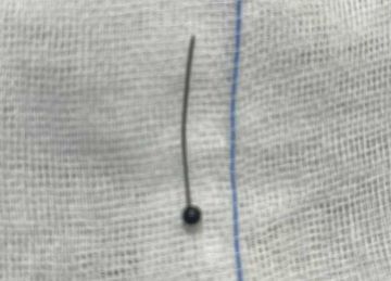 إنقاذ فتاة ابتلعت دبوس حجاب بمستشفى جامعة المنوفية