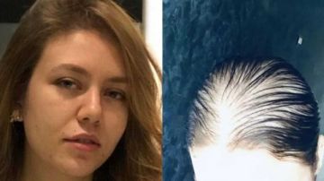 بعد إصابة الفنانة رحمة حسن.. طبيب شهير يكشف 5 طرق سحرية لعلاج الصلع نهائيا