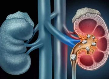  بلاش تاكل برجر .. 5 عادات تسبب فشل كلوى لا رجعة فيه