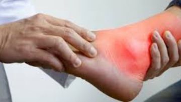 نبات طبيعي الحل الأمثل لتقليل التورم والالتهابات وعلاج النقرس