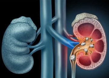 منها الشاي وعصير البرتقال.. 7 مشروبات ممنوعة لمرضى الكلى
