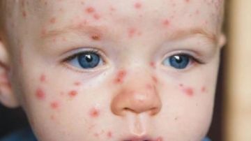 استشاري حساسية ومناعة يوضح الفرق بين الجدري والجدري المائي