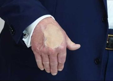 بعد تجربة ترامب الفاشلة.. كيف يمكن استخدام مستحضرات التجميل في تغطية الكدمات والندوب؟