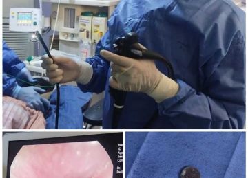 ابتعلت عملة معدنية .. فريق طبي ينجح في إنقاذ حياة طفلة بمستشفى أبو كبير بـ الشرقية