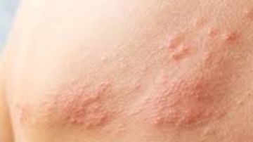 كشف طريقة علاج الإصابة بالحزام النارى .. فاكسيرا