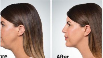 بدون جراحة وعمليات.. طرق سحرية لـ تقليل دهون الوجه بشكل طبيعي