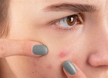 ليه بشرتك ما بتصفاش؟ .. 7 عادات يومية تسبب ظهور حب الشباب ليه بشرتك ما بتصفاش؟ .. 7 عادات يومية تسبب ظهور حب الشباب