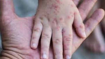 مرض معد.. تفاصيل وطرق الإصابة بالجدري المائي وتأثيره على الكبار مرض معد.. تفاصيل وطرق الإصابة بالجدري المائي وتأثيره على الكبار