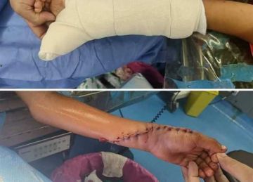 صحة دمياط : فريق طبي يتمكن من إنقاذ حالة بتر لطفل بعد تدخل جراحي دقيق صحة دمياط : فريق طبي يتمكن من إنقاذ حالة بتر لطفل بعد تدخل جراحي دقيق