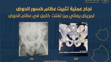 نجاح جراحة دقيقة لتثبيت كسر بالحوض بمجمع الأقصر الطبي
