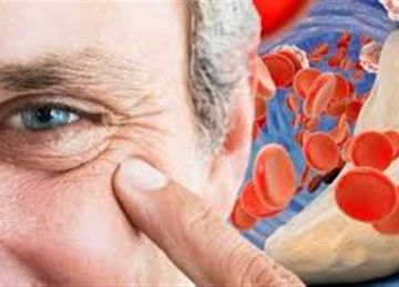 منها ضعف الذاكرة.. علامات غريبة تدل على ارتفاع الكوليسترول