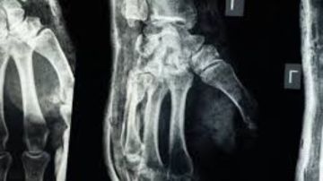 نشرة المرأة والمنوعات لاصق طبي يصلح العظام المكسورة في 3 دقائق.. وهذه مخاطر تأخير وجبة الإفطار لكبار السن