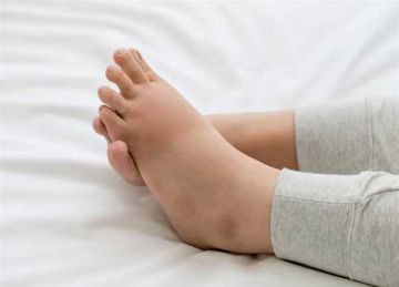 تورم القدمين ممكن يكون عرض بسيط أو علامة على مرض خطير