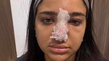  كنت هفقد مناخيري وأتعمي! .. البلوجر كنزي مدبولي تكشف خطورة حقن الفيلر