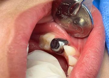 كان يعاني من تسوس الرضاعة.. نجاح جراحة دقيقة لتأهيل الأسنان اللبنية لطفل في مستشفى بالغربية