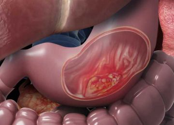  يتلف الحمض النووي .. كيف يتسبب نقص فيتامين أ في إصابتك بسرطان المعدة؟