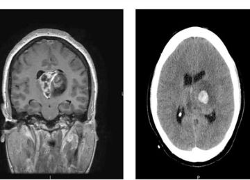  حلقات متمردة .. علماء يكشفون عن حمض نووي يؤدي إلى تطور السرطان