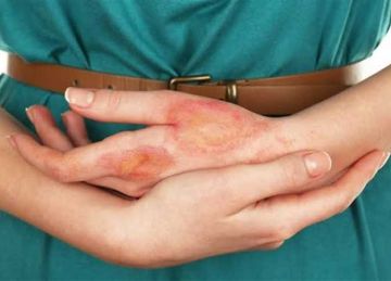 لو اتلسعتي في المطبخ.. 7 حلول فعالة لعلاج الحروق ومنع المضاعفات