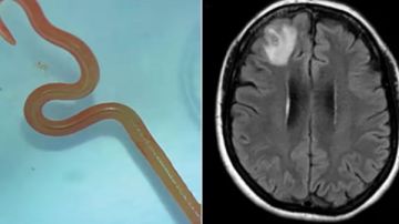 بسبب ثعبان نيء.. دودة حية طولها 18 سم في دماغ رجل صيني