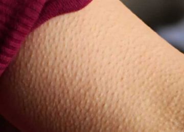 بشرة ناعمة كالأطفال بدون ليزر.. طرق طبيعية للتخلص من جلد الوزة