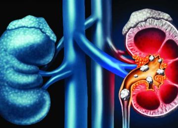  مش هتحتاج دكتور .. علاجات منزلية لا تخطر على بالك للتخلص من حصوات الكلى
