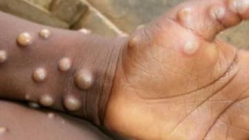 دخل حالة الطوارئ وطلع تانى .. كيف تنتقل عدوى جدري القرود