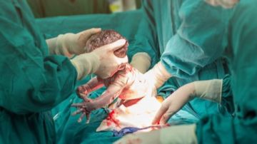 متحدث الصحة: 6 طرق لقياس وتقييم الولادة القيصرية