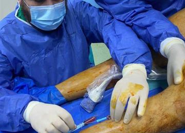 إجراء أول جراحة بالتردد الحراري لعلاج دوالي ساق نازفة بمستشفى المبرة بالمحلة