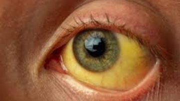 ارتفاع الإنزيمات .. الأسباب والنصائح الفعالة للحفاظ على صحة الكبد ارتفاع الإنزيمات .. الأسباب والنصائح الفعالة للحفاظ على صحة الكبد