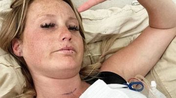 أم تحذر من البوتوكس بعد إصابتها بالشلل بحقنة تجميلية