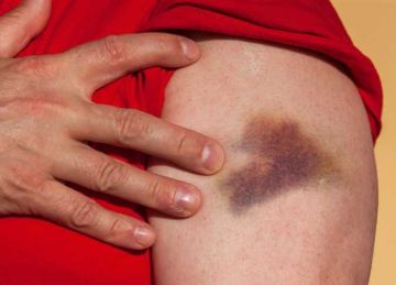 هل ترى كدمات عشوائية على جسمك دون سبب؟.. إليك السر وراء ذلك