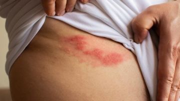 مرض فيروسي يصيب الأعصاب والجلد.. أسباب وأعراض الحزام الناري