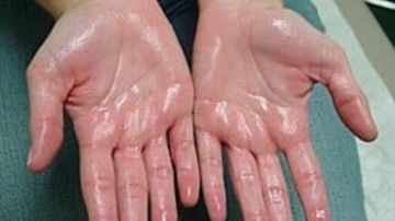 مبرة طنطا.. أكثر من 120 عملية لعلاج تعرق اليدين عند الأطفال