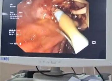 بدون جراحة.. استئصال ورم بالقنوات المرارية لمريض بمستشفى أحمد ماهر التعليمي بدون جراحة.. استئصال ورم بالقنوات المرارية لمريض بمستشفى أحمد ماهر التعليمي