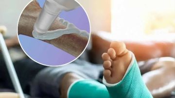 ابتكار طبي صيني.. لاصق عظام يعالج الكسور في دقائق دون جراحة