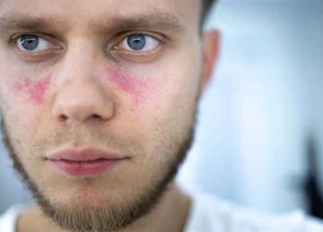 قلبك وكليتك في خطر.. ما هو مرض الذئبة وكيف يؤثر على الجسم؟